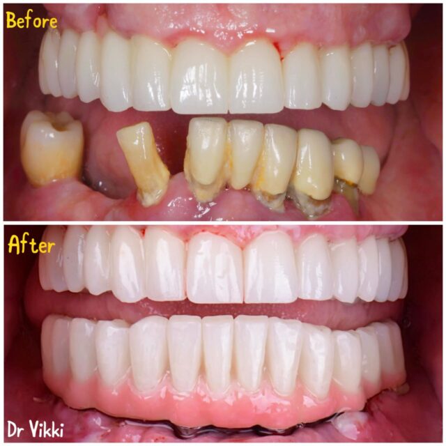 🌟Changing one smile at a time🌟

📍Yuvanoglu Dental Clinic 
☎️ +30 210 894 0648

#implants #implantdentistry #smilemakeover #lifechangingdentistry #shining3d #dentist #glyfada #athens #ilovemyjob