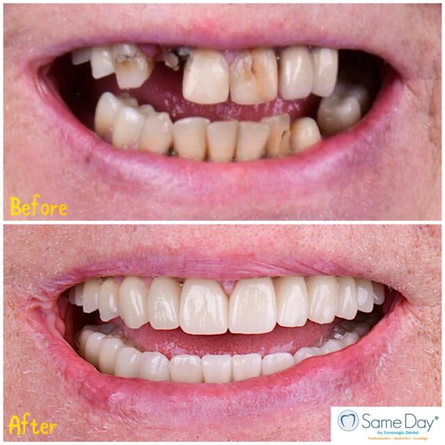 🌟Full Mouth Rehabilitation🌟

📍Yuvanoglu Dental Clinic 
☎️ +30 210 894 0648

📍Glyfada, Athens

#smilemakeover #fullmouthrehabilitation #dentalimplants #athens #ilovemyjob