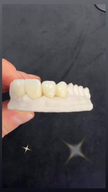 POV: the smile you’ve been waiting for 😍

Where aesthetics meets function - because details make the difference 🤩🦷🤩

📍Yuvanoglu Dental Clinic 
☎️ +30 210 894 0648

📍Glyfada, Athens

#smile #cosmeticdentistry #dentalcrowns #athens #ilovemyjob