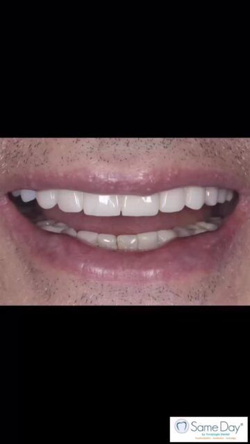 🇬🇧Missing teeth don’t just affect your smile—they impact function, confidence, and long-term oral health.

This case shows a 3-unit implant-supported bridge, restoring both aesthetics and function with a natural-looking result.

✅Stable
✅Long-lasting
✅Feels like your own teeth

Thinking about dental implants? Send us a message to learn more.

🇬🇷Λείπουν δόντια; Δεν επηρεάζεται μόνο το χαμόγελο, αλλά και η λειτουργία, η αυτοπεποίθηση και η συνολική στοματική υγεία.

Το περιστατικό αυτό δείχνει μια γέφυρα 3 δοντιών πάνω σε εμφυτεύματα, αποκαθιστώντας τόσο την αισθητική όσο και την λειτουργική με φυσικό αποτέλεσμα.

✅Σταθερότητα
✅Μακροχρόνια λύση
✅Αίσθηση φυσικών δοντιών

Σκέφτεστε τα εμφυτεύματα; Στείλτε μας μήνυμα για να ενημερωθείτε.

📍Yuvanoglu Dental Clinic 
☎️ +30 210 894 0648

📍Glyfada, Athens

#dentalimplants #digitaldentistry #cosmeticdentistry #smiledesign #ilovemyjob