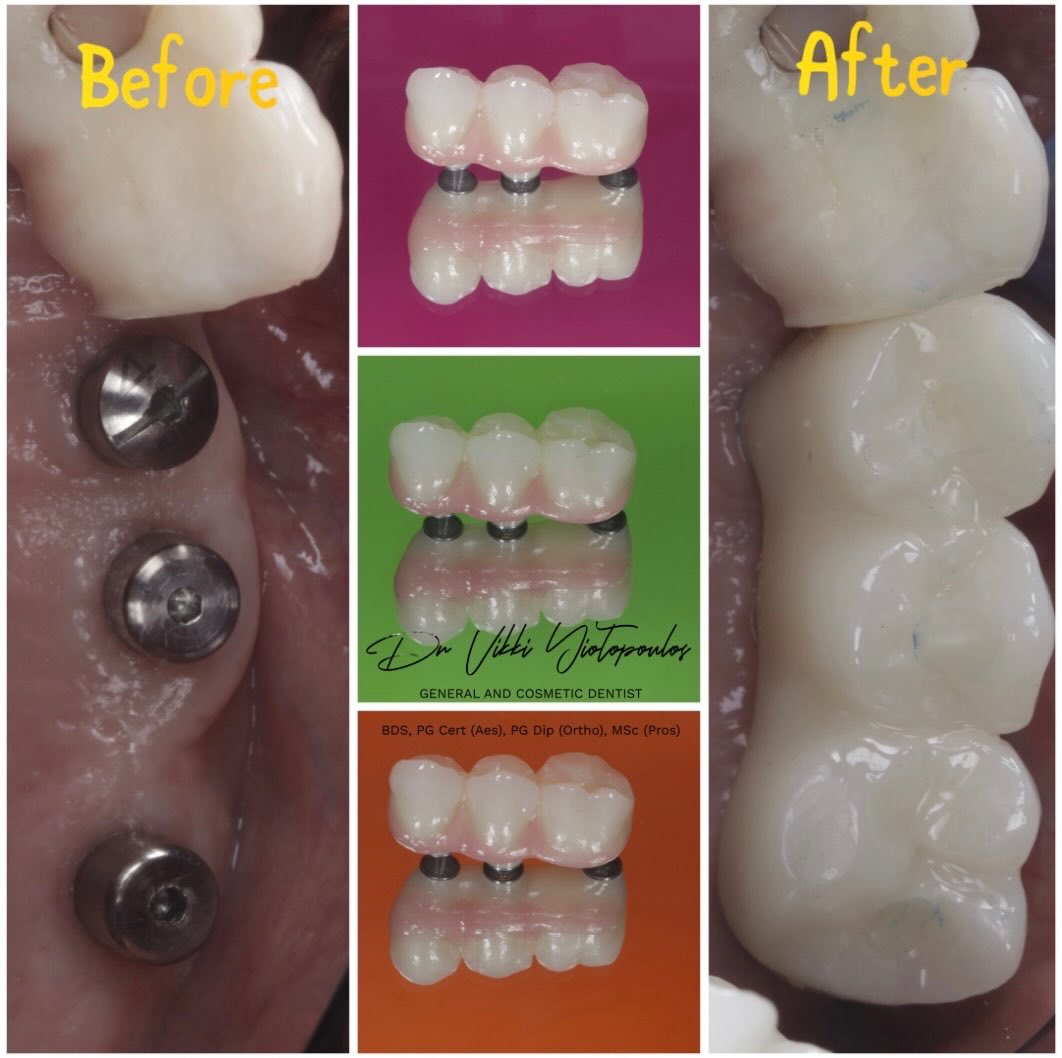 It’s all in the details!! 😍🦷😍

#dentalimplants #digitaldentistry #cosmeticdentistry #athens #ilovemyjob
