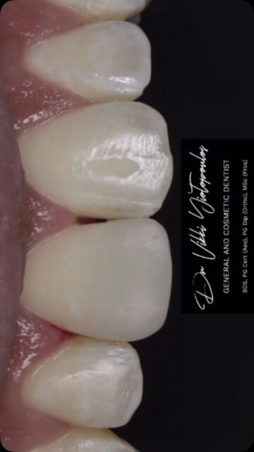 When the unexpected happens 🚨🦷

Repairing a fractured front tooth with direct composite bonding, carefully recreating the shape, proportions and natural anatomy of the tooth — while keeping the result beautifully natural. 🤍

Because cosmetic dentistry isn’t always about changing your smile… sometimes it’s about restoring what was already there. ✨

Natural. Conservative. Individualised.

📍Aesthetic & Restorative Dentistry

📍Yuvanoglu Dental Clinic 
☎️ +30 210 894 0648
👩🏻‍⚕️ Dr Vikki Yiotopoulos

📍Glyfada, Athens

#composite #cosmeticdentistry #smile #smilemakeover #athens