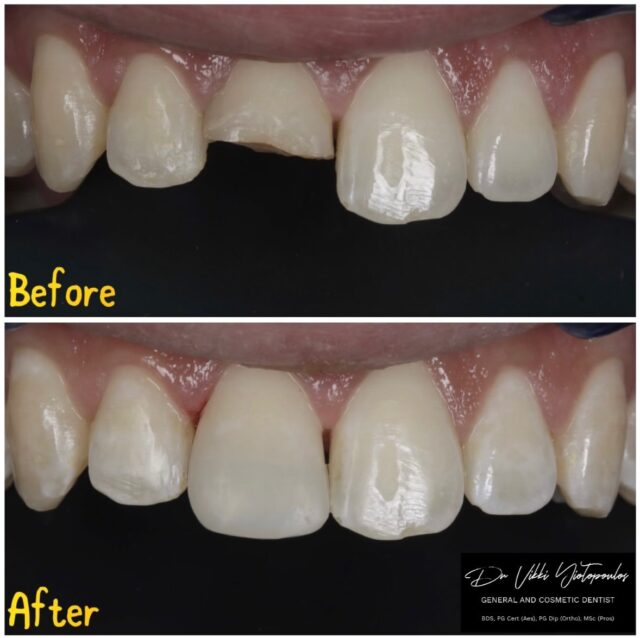 Let’s take a closer look 👀😍👀

📍Yuvanoglu Dental Clinic 
☎️ +30 210 894 0648
👩🏻‍⚕️ Dr Vikki Yiotopoulos

📍Glyfada, Athens

#composite #cosmeticdentistry #smile #smilemakeover #athens