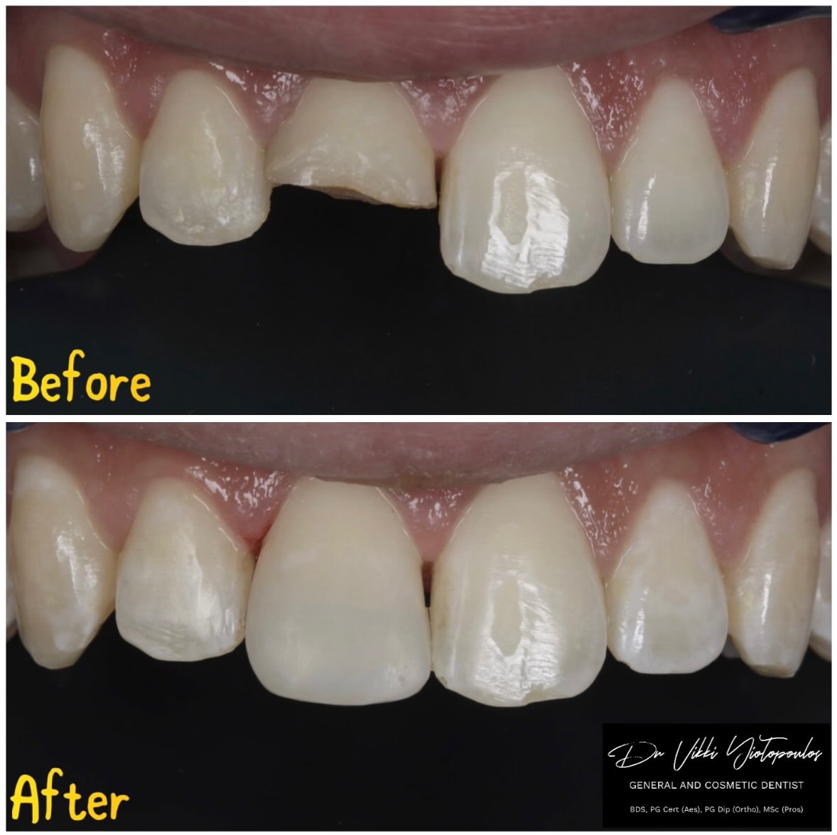 Let’s take a closer look 👀😍👀

📍Yuvanoglu Dental Clinic 
☎️ +30 210 894 0648
👩🏻‍⚕️ Dr Vikki Yiotopoulos

📍Glyfada, Athens

#composite #cosmeticdentistry #smile #smilemakeover #athens
