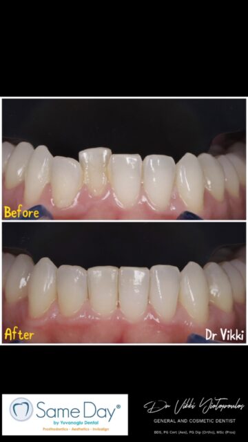✨ A straighter smile in just 16 weeks. ✨

This Invisalign® case is a great example of how much can be achieved in a relatively short time with carefully planned clear aligner treatment.

The lower teeth were noticeably crowded and rotated, and after just 16 weeks, we achieved a beautifully aligned and more harmonious smile. 🤍

🦷 No metal braces.
✨ Discreet, removable aligners.
⏱️ Just 16 weeks of treatment.

Every smile is different, and treatment time depends on the individual case, but with digital planning and the right treatment approach, sometimes the transformation can happen sooner than you expect.

Thinking about straightening your teeth without traditional braces?
Send me a DM to arrange a consultation and find out what Invisalign® could achieve for your smile. ✨

📍Yuvanoglu Dental Clinic 
☎️ +30 210 894 0648

📍Glyfada, Athens

#invisalign #orthodontics #smilemakeover #smile #athens