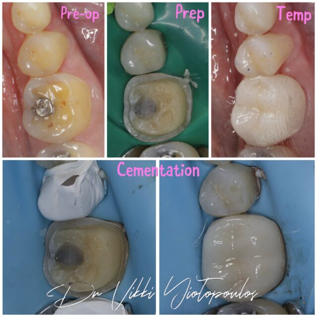 🦷 Restoring a tooth doesn’t always mean preparing it for a full crown.

An onlay restoration can be used to restore a heavily restored or structurally compromised tooth while preserving as much healthy tooth structure as possible.

Unlike a conventional crown, an onlay is designed to replace only the areas of the tooth that require restoration — by covering the weakened cusps while maintaining healthy tooth structure around them.

In this case, the onlay restorations formed part of a full-mouth rehabilitation, allowing us to increase the vertical dimension of occlusion (VDO) and restore the patient’s function, occlusion and tooth proportions.

The advantage of an adhesive onlay approach is that we can restore and protect the compromised tooth while being conservative with the remaining healthy tooth structure.

✨ Why choose an onlay?
• Restore heavily restored and compromised teeth
• Conservative preparation
• Preserves more healthy natural tooth structure
• Reinforces weakened areas of the tooth
• Restores function and strength
• Re-establish functional occlusion
• Increase VDO in a controlled way
• Restore natural anatomy and proportions
• Use an adhesive, minimally invasive approach
• Can provide excellent long-term aesthetics

The goal of modern restorative dentistry isn’t simply to replace what is missing — it’s to preserve what is healthy. 🤍

Every tooth is different, so the most appropriate restoration depends on the remaining tooth structure, occlusion, cracks/caries and overall clinical situation.

Conservative dentistry. Stronger teeth. Natural results.

#adhesivedentistry #conservativedentistry #minimallyinvasivedentistry #dentist #athens